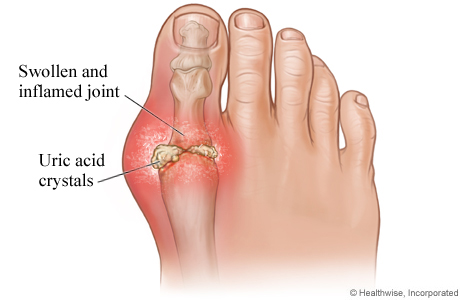 gout big toe - uric acid