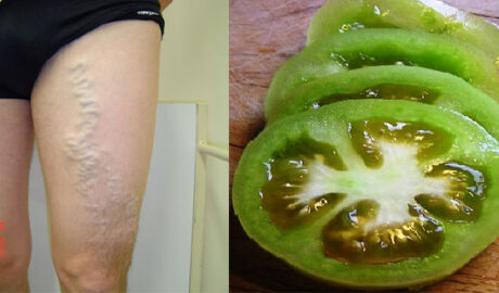 How to Treat and Cure Varicose Veins with Tomatoes