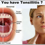 Recipe to Cure Tonsillitis