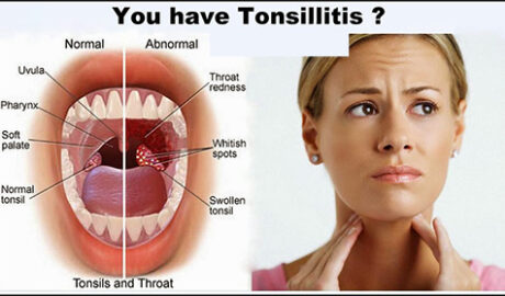 Recipe to Cure Tonsillitis