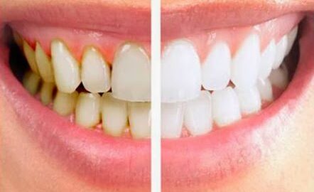 4 Natural Homemade Remedies to Remove Teeth Plaque