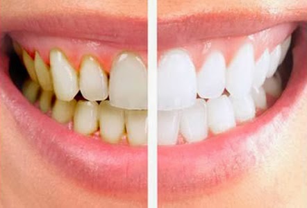 4 Natural Homemade Remedies to Remove Teeth Plaque
