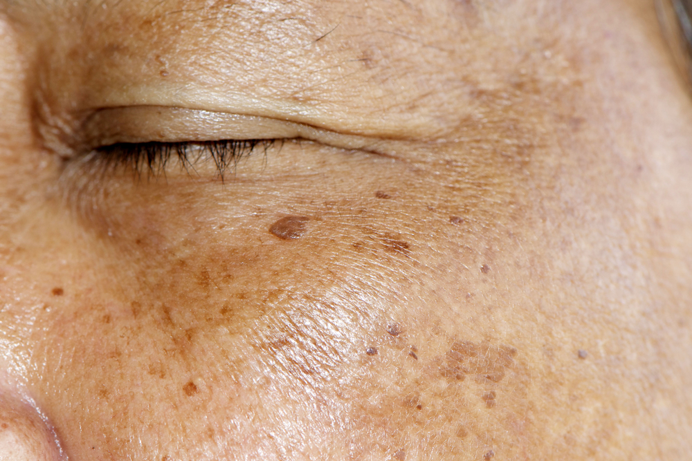 Dark Spots: What Are They & How To Treat Them