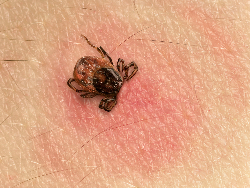 Close-up of tick on human skin.
